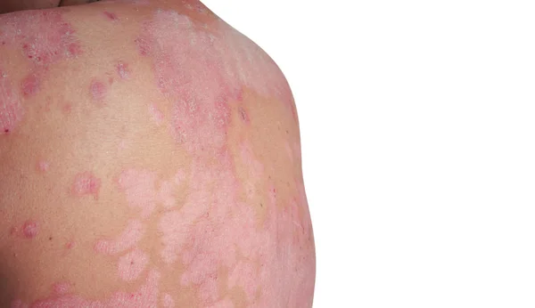 Псориаз - кожное заболевание — стоковое фото
