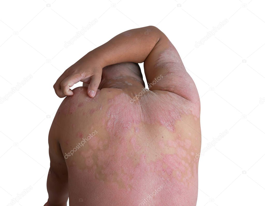Men using hands scratch the shoulder ulcers