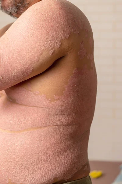 淋巴异常引起的疾病 银屑病是一种皮肤病 — 图库照片