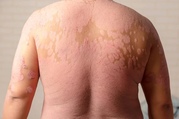 Malattie Causate Anomalie Della Linfa Psoriasi Una Malattia Della Pelle — Foto Stock