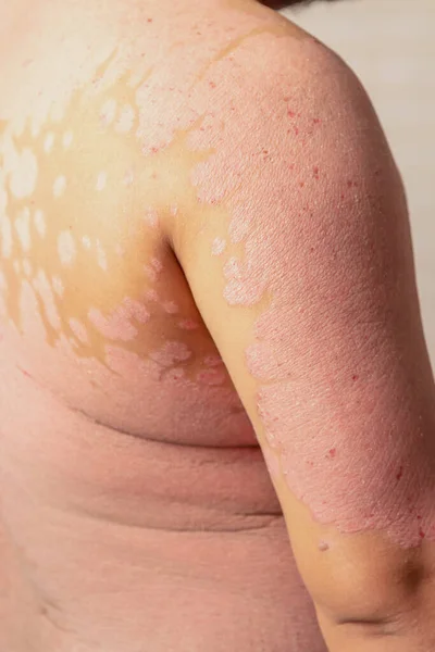 Choroby Spowodowane Nieprawidłowościami Limfy Łuszczyca Jest Chorobą Skóry — Zdjęcie stockowe