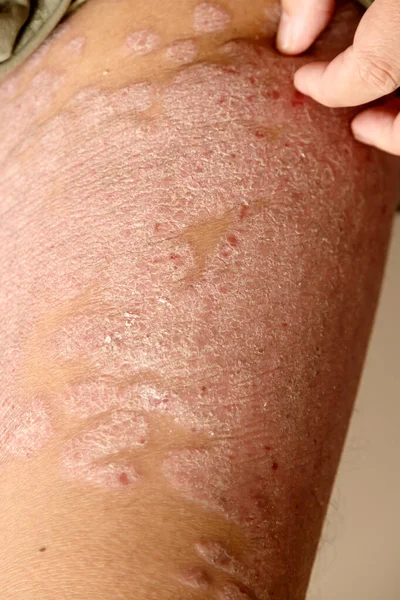 Maladies Causées Par Des Anomalies Lymphe Psoriasis Est Une Maladie — Photo