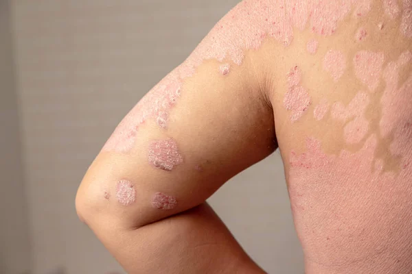 Maladies Causées Par Des Anomalies Lymphe Psoriasis Est Une Maladie — Photo