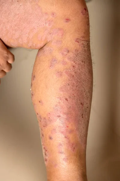 Maladies Causées Par Des Anomalies Lymphe Psoriasis Est Une Maladie — Photo