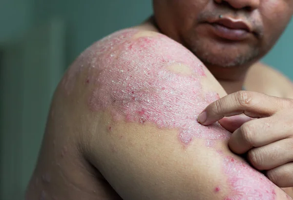 Homens Usam Mãos Para Coçar Ferida Nos Braços Doenças Causadas — Fotografia de Stock