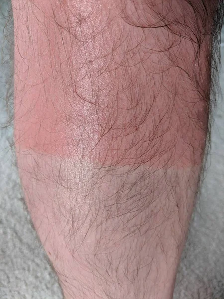 Burnt Skin on Hairy Leg of Caucasian Male