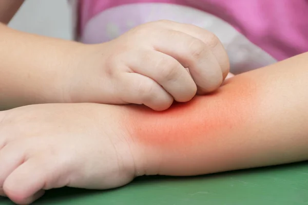 Los niños se rascan los brazos. Después de las picaduras de mosquitos . — Foto de Stock