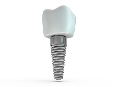 Diş implant diş hekimi, diş düzen, plastik, adam, diş tedavisi 3d render