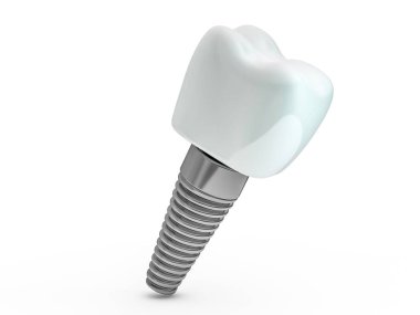 Diş implant diş hekimi, diş düzen, plastik, adam, diş tedavisi 3d render