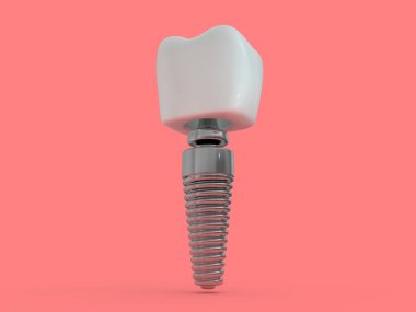 Diş implant diş hekimi, diş düzen, plastik, adam, diş tedavisi 3d render