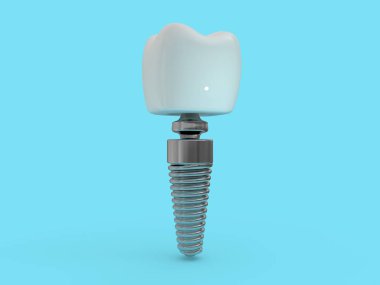Diş implant diş hekimi, diş düzen, plastik, adam, diş tedavisi 3d render