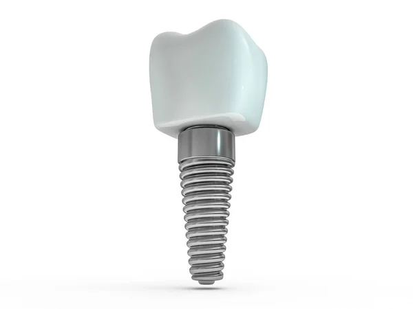 Dental Implant Dentysta Tworzyw Sztucznych Człowiek Ząb Układ Zębów Leczenie — Zdjęcie stockowe