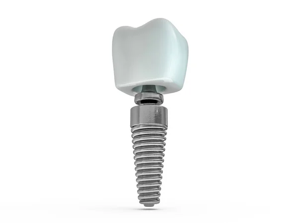 Zubní Implantát Zubař Zubní Rozložení Plasty Muž Zuby Léčby Vykreslování — Stock fotografie