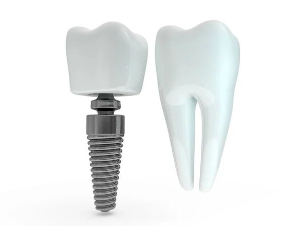 Tandimplantat Tand Layout Mannen Plast Tandläkare Tänder Behandling Rendering — Stockfoto