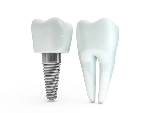 Dental Implant Tandarts Tand Lay Out Kunststoffen Man Tanden Behandeling — Stockfoto