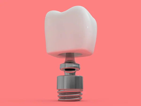 Implante Dental Dentista Diseño Dientes Plásticos Hombre Tratamiento Dientes Renderizado — Foto de Stock