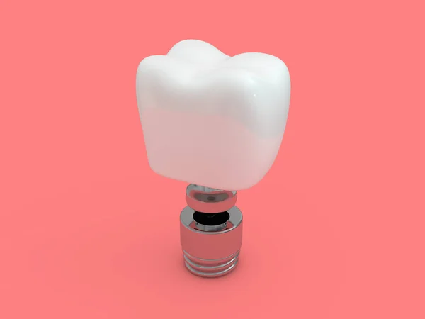 Dental Implant Tandarts Tand Lay Out Kunststoffen Man Tanden Behandeling — Stockfoto