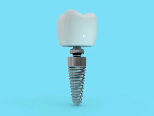 Dentista Implante Dentário Layout Dente Plásticos Homem Dentes Tratamento Renderização — Fotografia de Stock