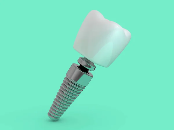 Зубной Имплантат Стоматолог Расположение Зубов Пластика Человек Обработка Зубов Рендеринг — стоковое фото