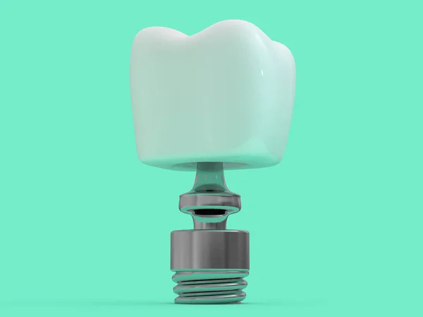 Zubní Implantát Zubař Zubní Rozložení Plasty Muž Zuby Léčby Vykreslování — Stock fotografie