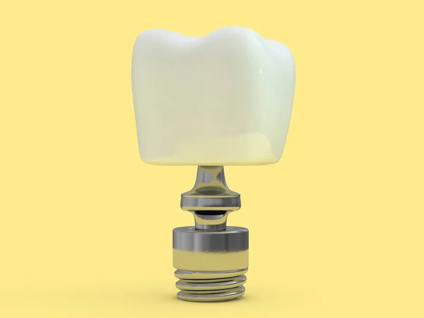 Implante Dental Dentista Diseño Dientes Plásticos Hombre Tratamiento Dientes Renderizado —  Fotos de Stock