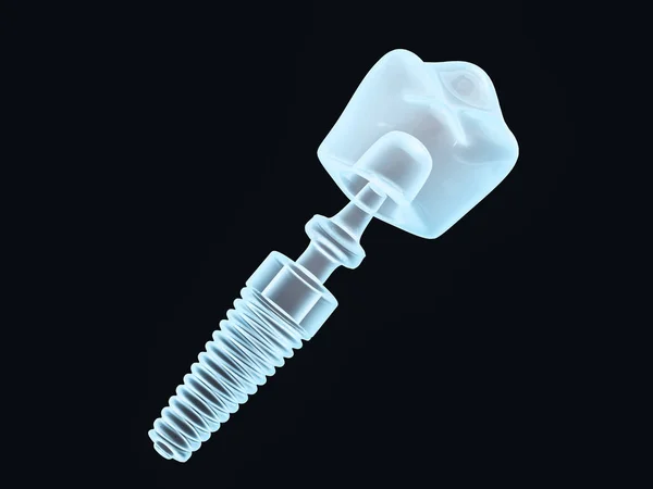 Стоматолог Імплантолог Схема Зубів Пластика Людина Лікування Зубів Візуалізація — стокове фото