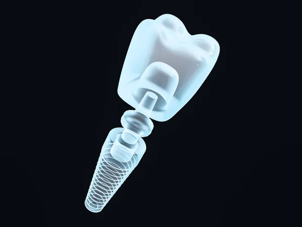 Dental Implant Dentist Tooth Layout Plastics Man Teeth Treatment Rendering — Stock Photo, Image