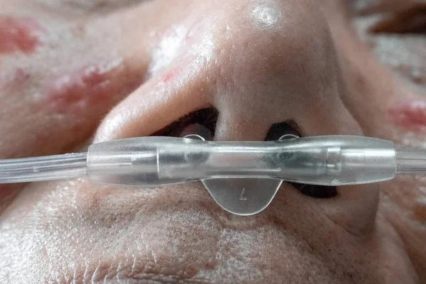 Efecto Error Medicación Pacientes Edad Avanzada Con Tubo Respiratorio Nasal — Foto de Stock