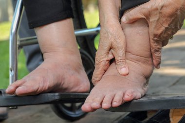 Yaşlı kadın şişmiş ayak basın test tekerlekli sandalye