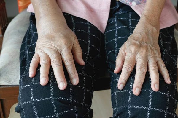 Пожилые опухшие руки или отек руки — стоковое фото