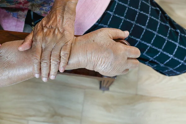 Ηλικιωμένοι πρησμένο χέρι ή οίδημα χέρι — Φωτογραφία Αρχείου