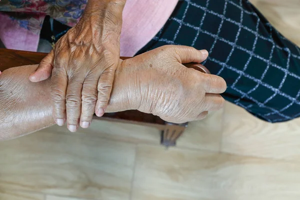 Anziani mano gonfia o edema mano — Foto Stock