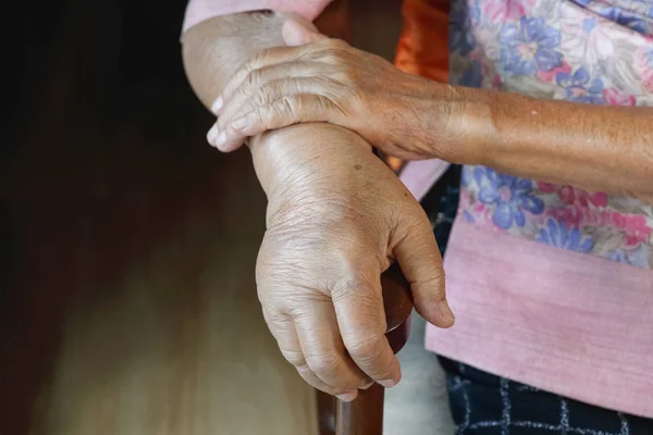 Idosos mão inchada ou mão edema — Fotografia de Stock