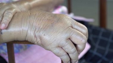 Yaşlı şişmiş el veya ödem el