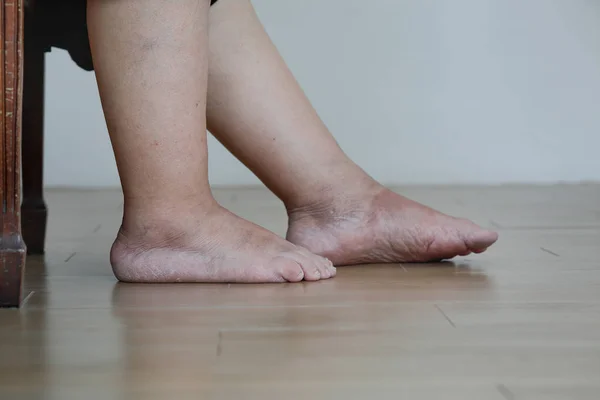 Старшая женщина опухшие ноги и ноги — стоковое фото