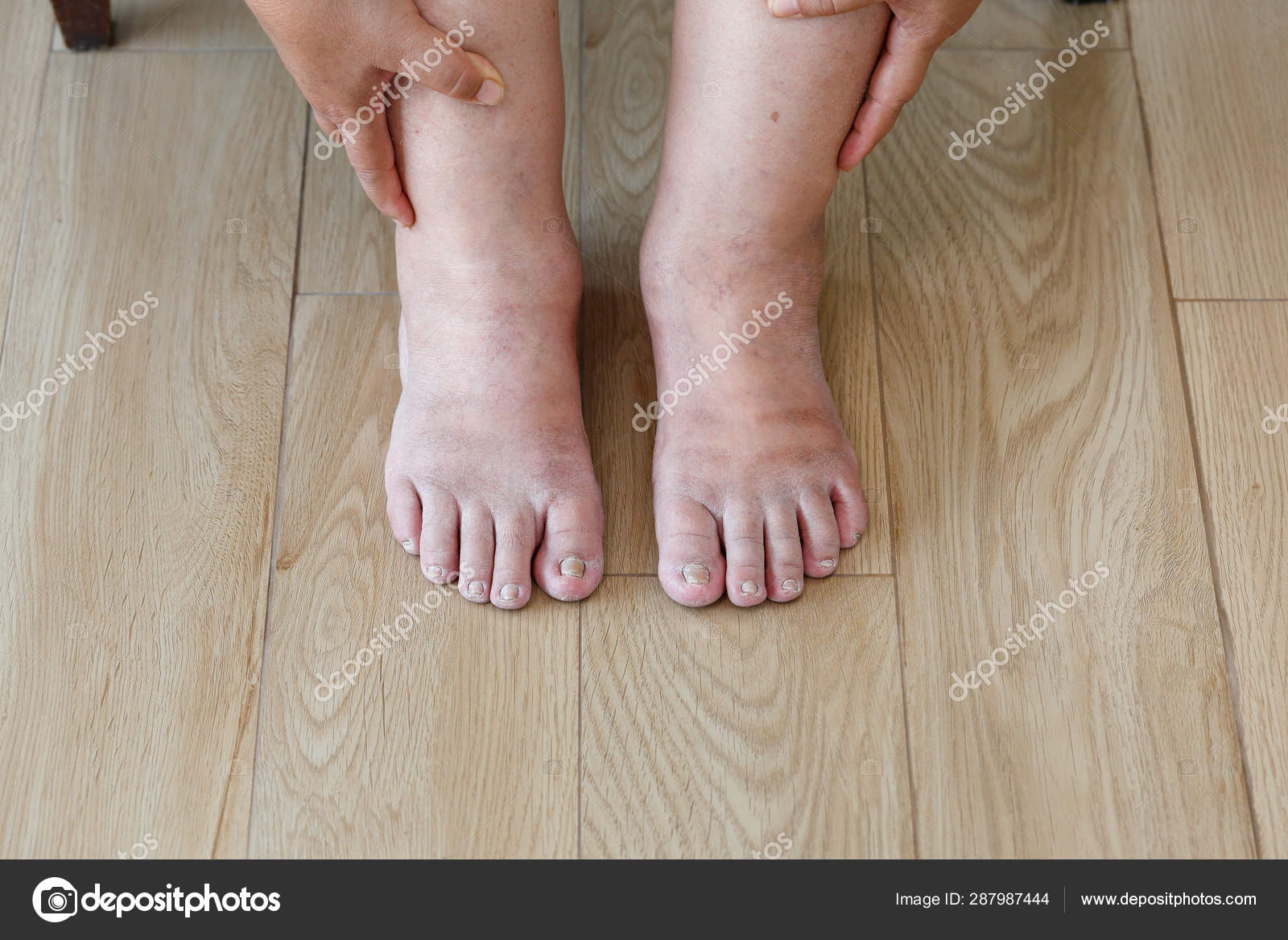 Пастозность тела. Отеки при сердечной недостаточности. Пастозность тела. Пастозность лимфостаз. Отеки при сердечной недостаточности.