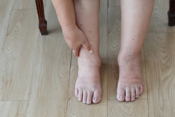 Senior vrouw gezwollen voeten en been — Stockfoto