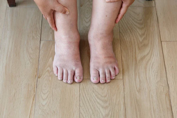 Seniorin geschwollene Füße und Beine — Stockfoto