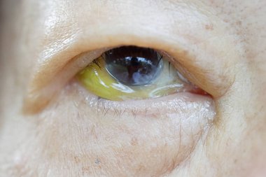 Sarılık belirtileri ve Hepatit C Virüs0 Komplikasyonları (Hcv)