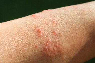 kol fiberglas döküm nedeniyle alerjik belirtiler olarak deri döküntüsü