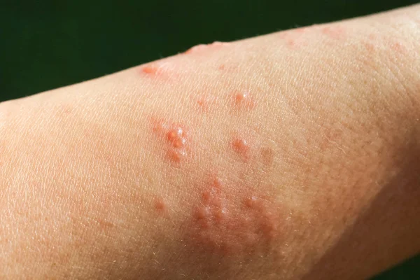 Hudutslag som allergiska symtom på grund av arm glasfiber gjutna — Stockfoto
