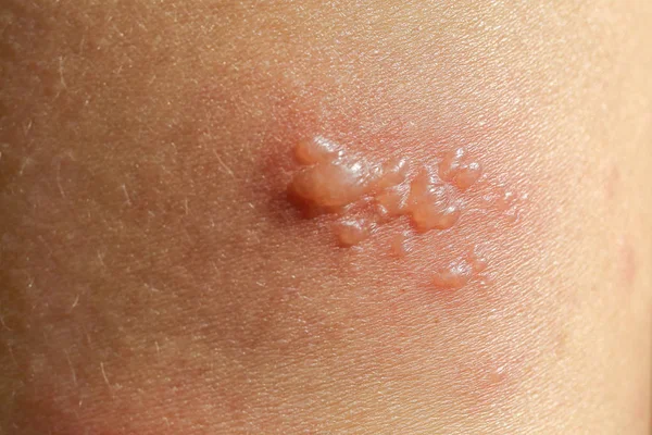 Bőrkiütés, mint allergiás tünetek miatt kar üvegszálas öntött Jogdíjmentes Stock Képek