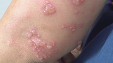 Kolda Zona, Zoster veya Herpes Zoster belirtileri