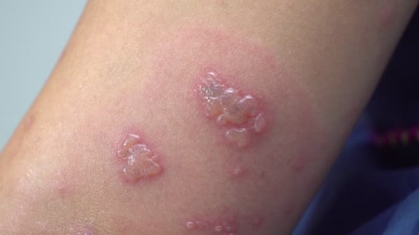 Shingles Zoster Herpes Zoster Symptoms Arm Stock Video Footage by ©toa55  #309032792