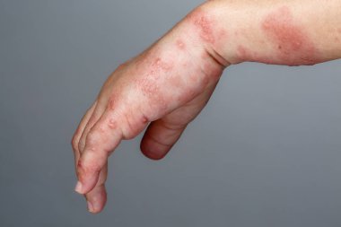 Kolda Zona, Zoster veya Herpes Zoster belirtileri