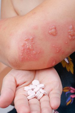 Zona, Zoster veya Herpes Zoster belirtileri antiviral ilaç ile