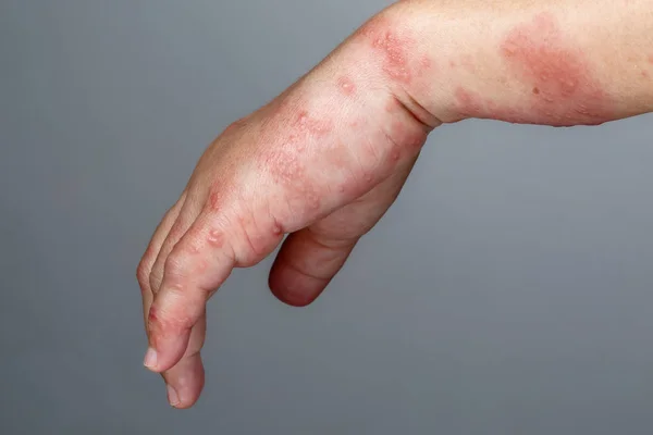 手臂上的石膏、佐斯特或疱疹佐斯特症状 — 图库照片