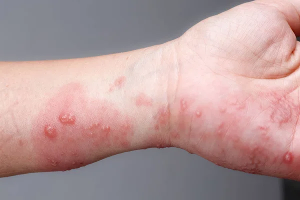Bältros, zoster eller herpes zoster symtom på armen — Stockfoto