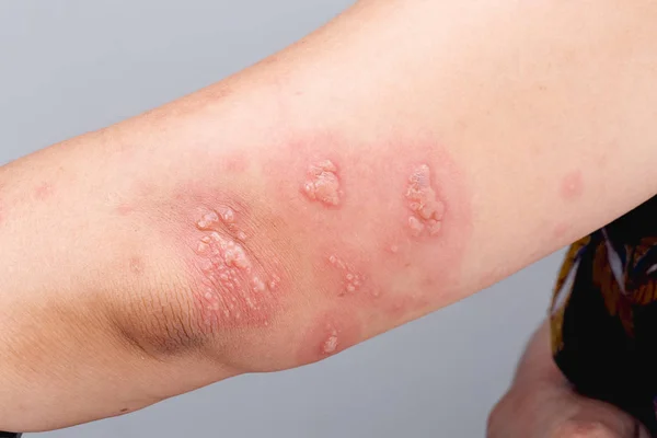 Shingles, Zoster or Herpes Zoster symptoms on arm — Stock Photo, Image