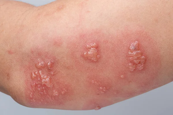 Bältros, zoster eller herpes zoster symtom på armen — Stockfoto